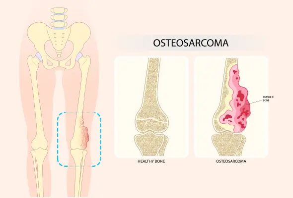 osteosarkoma kanker tulang